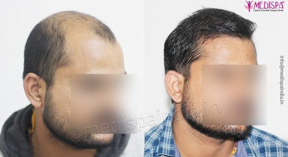 How To Get Natural Hairline By Hair Transplant