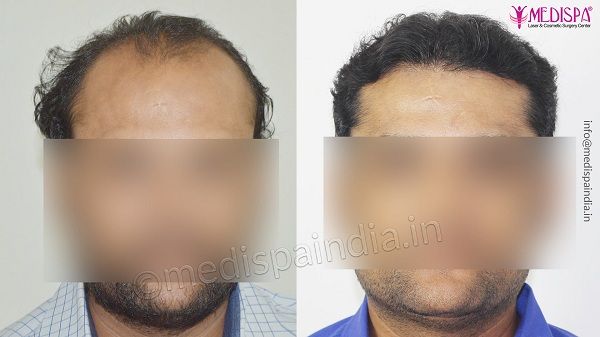 How To Overcome Male Pattern Baldness By Hair Transplantation