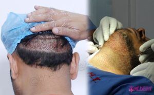 When to choose FUT or FUE Hair Transplant Technique