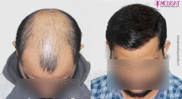 How Can Hair Transplant Help in Curing Pattern Baldness Issue?