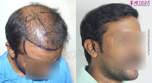 Is Hair Restoration A Successful Treatment For Hair Loss?