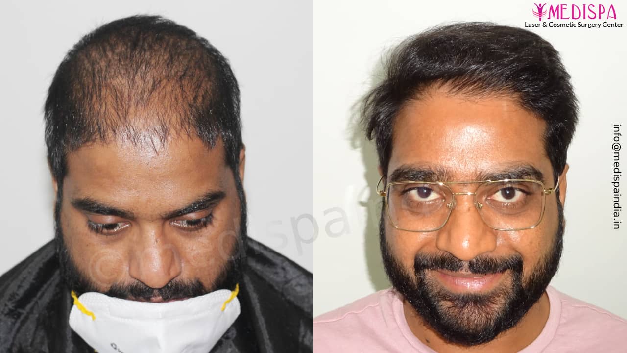 hair transplant cost in india