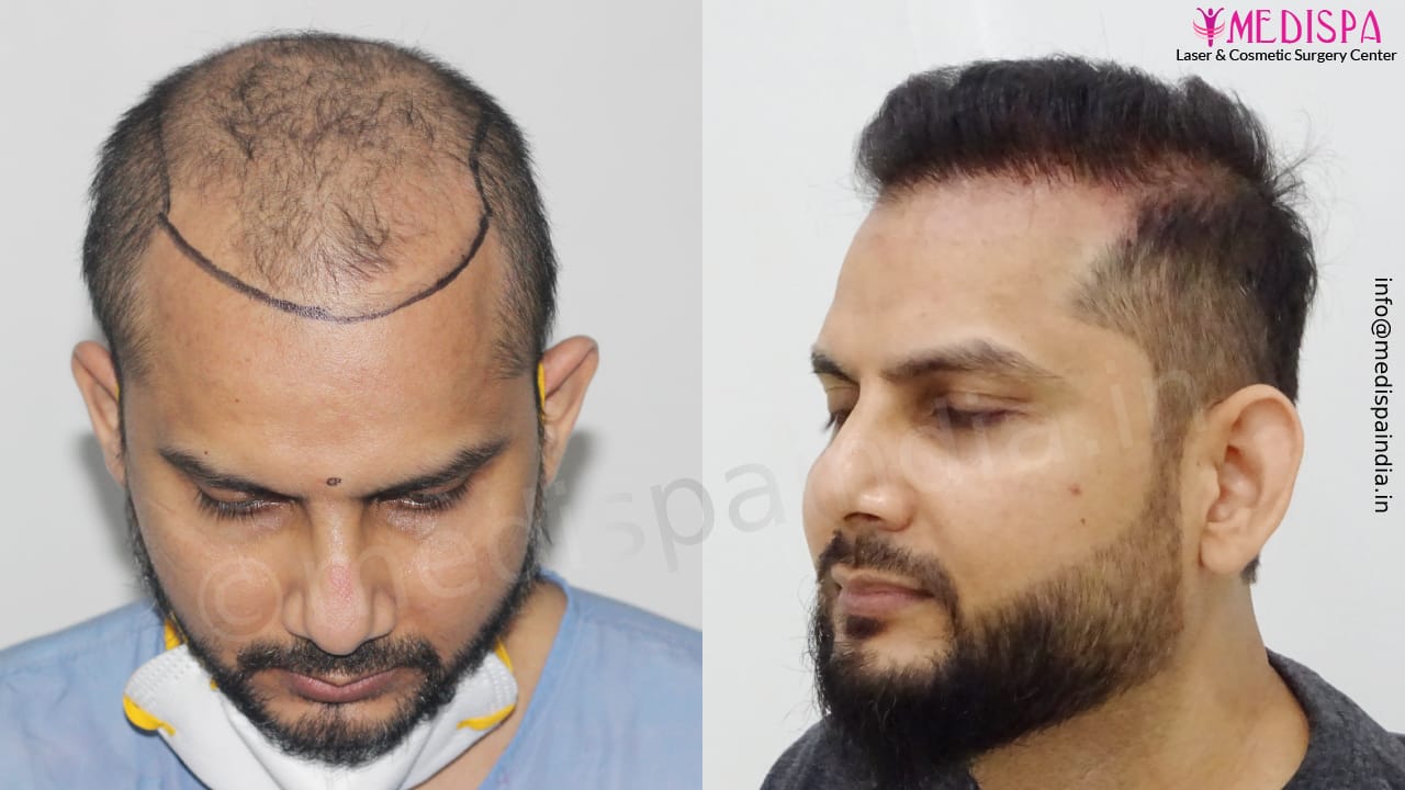 hair transplant cost in india