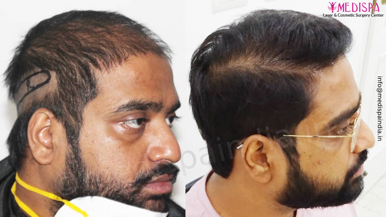 hair transplant cost in pune