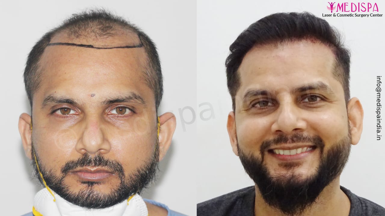 Norwood Class 7 hair transplant