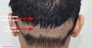 Why FUT+FUE combine method considered the best for hair transplantation?