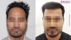 Explain The Techniques That Provide The Best Hair Transplant Treatment