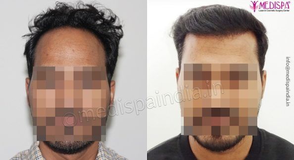 What Are The Factors To Be Considered Before Hair Transplant Surgery