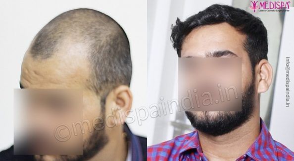 How To Get Maximum Hair Density From Hair Transplantation