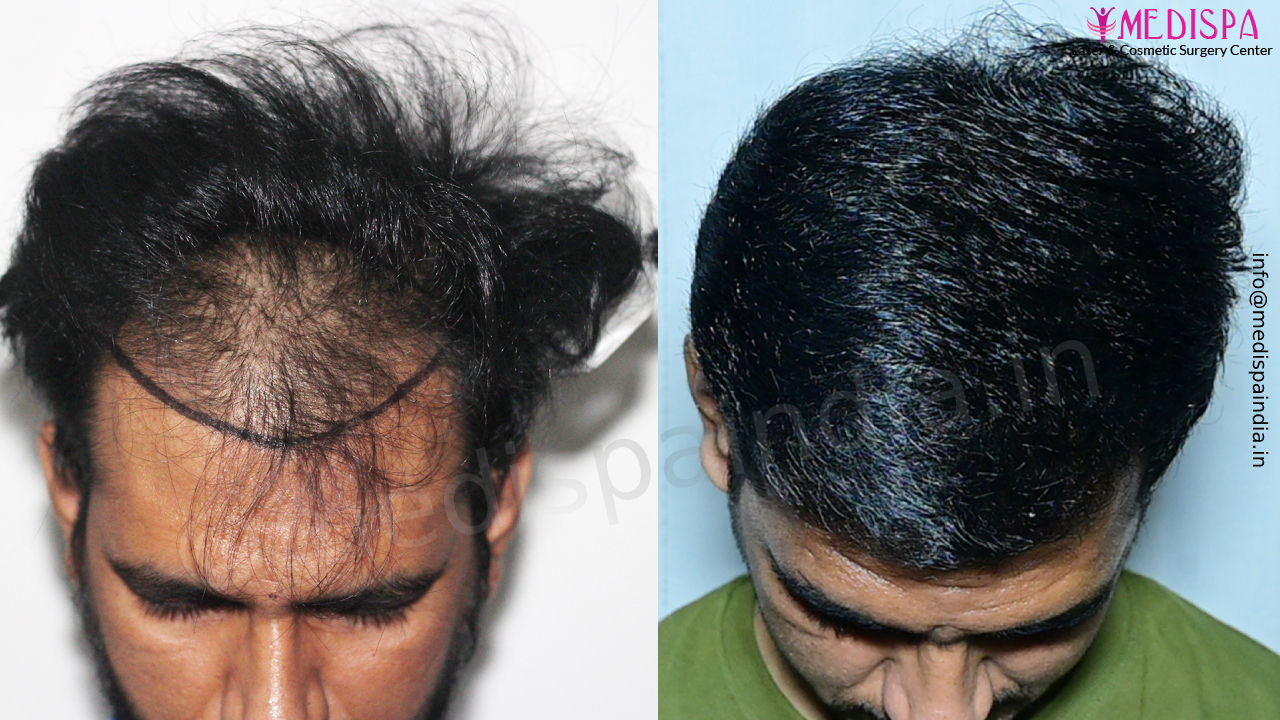 before after hair transplant results