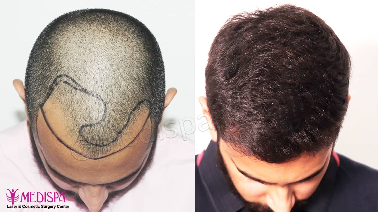 best hair transplant in Delhi