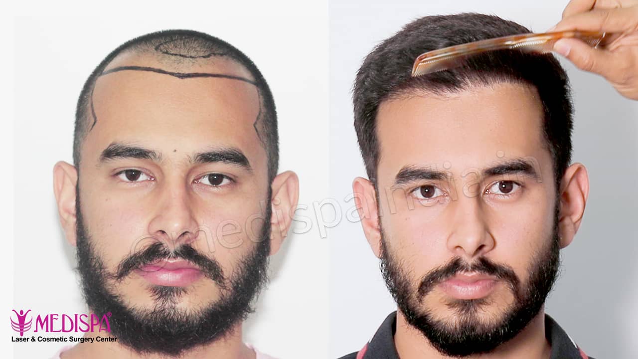 best hair transplant india