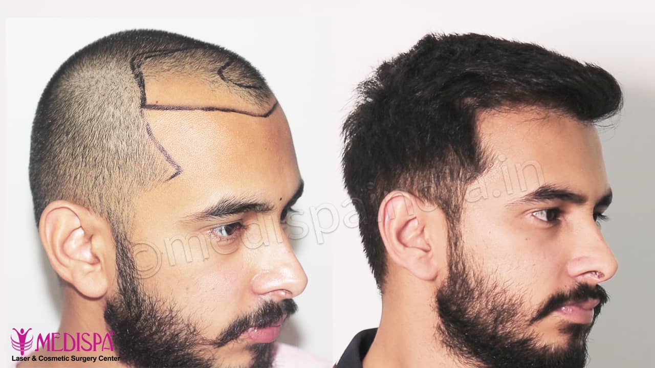 best hair transplant delhi