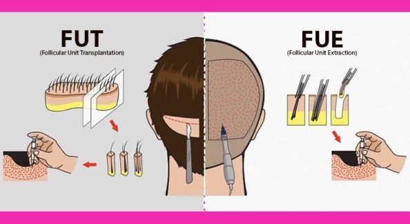 Difference between FUT and FUE hair transplant technique