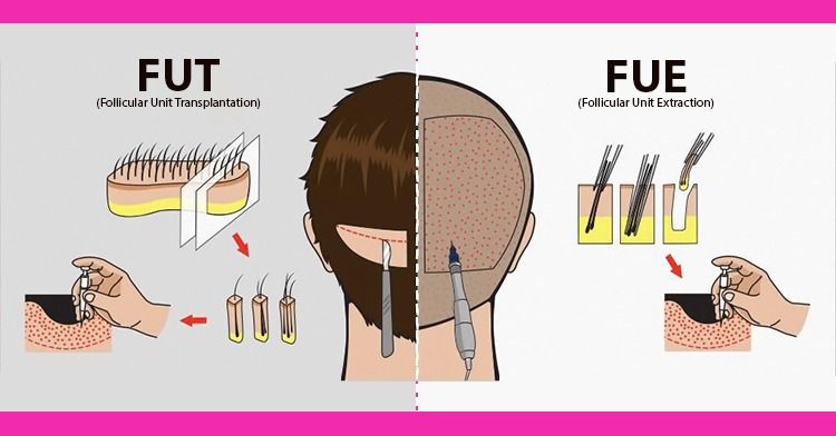 Difference between FUT and FUE hair transplant technique
