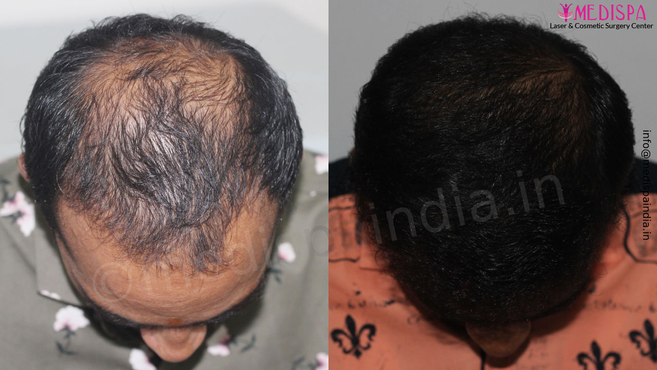 hair restoration india