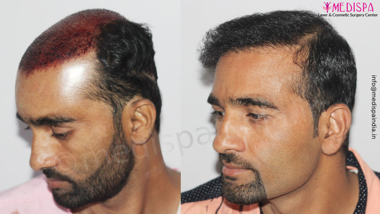 hair restoration jaipur