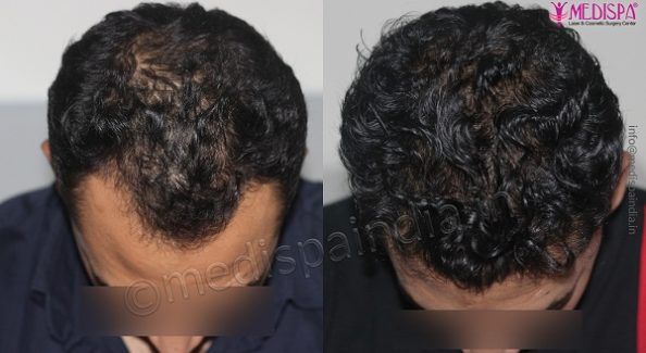 Explain The Attributes of A Hair Transplant Surgeon