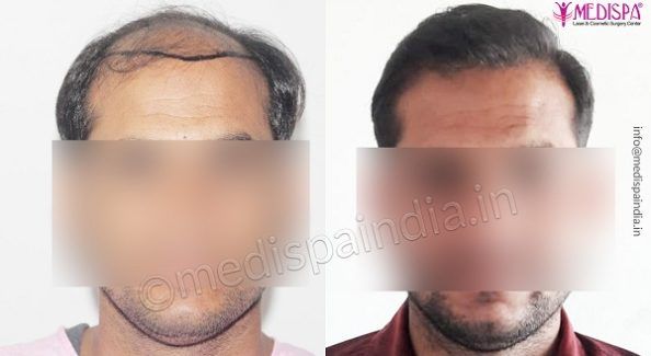 Significant Things To Know Before Undergoing Hair Transplant Surgery