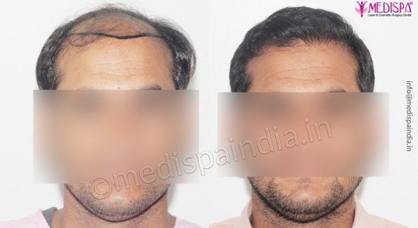 Is Hair Transplant Better Than Medicines