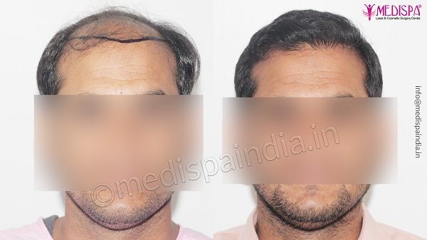 Is Hair Transplant Better Than Medicines
