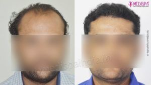 Is Hair Transplant Procedure Really a Successful Treatment For Hair Loss?