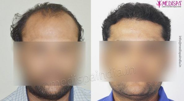Is Hair Transplant Procedure Really a Successful Treatment For Hair Loss