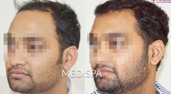 What Is The Right Age To Get Hair Transplant Treatment