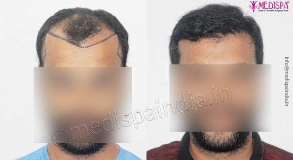 Why is it Important To Choose an Authentic Hair Transplant Clinic