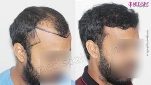 How To Know Which Hair Transplant Method Will Suit Me?