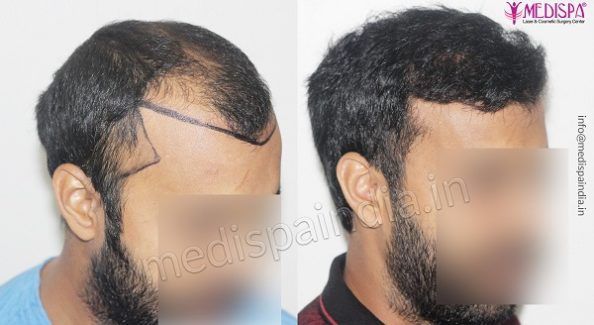 How To Know Which Hair Transplant Method Will Suit Me