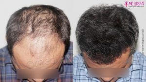 How To Get The Best Results With Hair Transplantation?