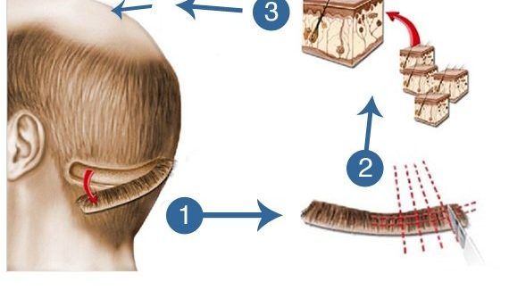 How Can FUT Hair Transplant Bring Back The Natural Looking Hair