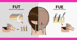 Why The Graft Damage in FUT is Less As Compared To FUE?