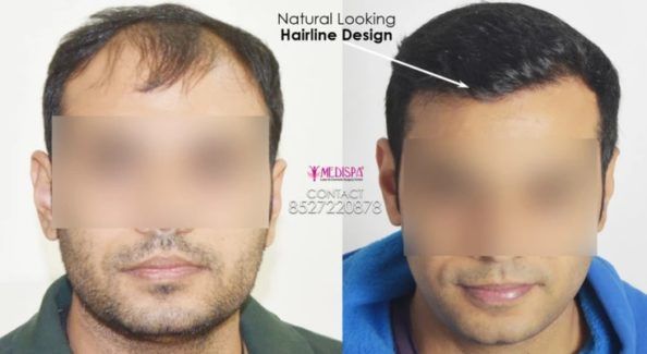 Is Hair Transplant The Best Way To Enhance Hair Growth And Density