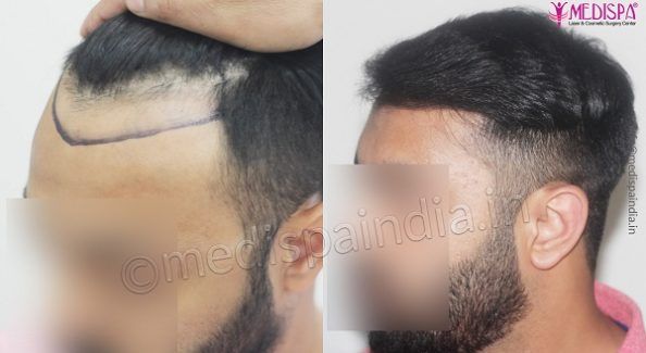 Why Consider Hair Transplant When You Are Dealing With Hair Loss