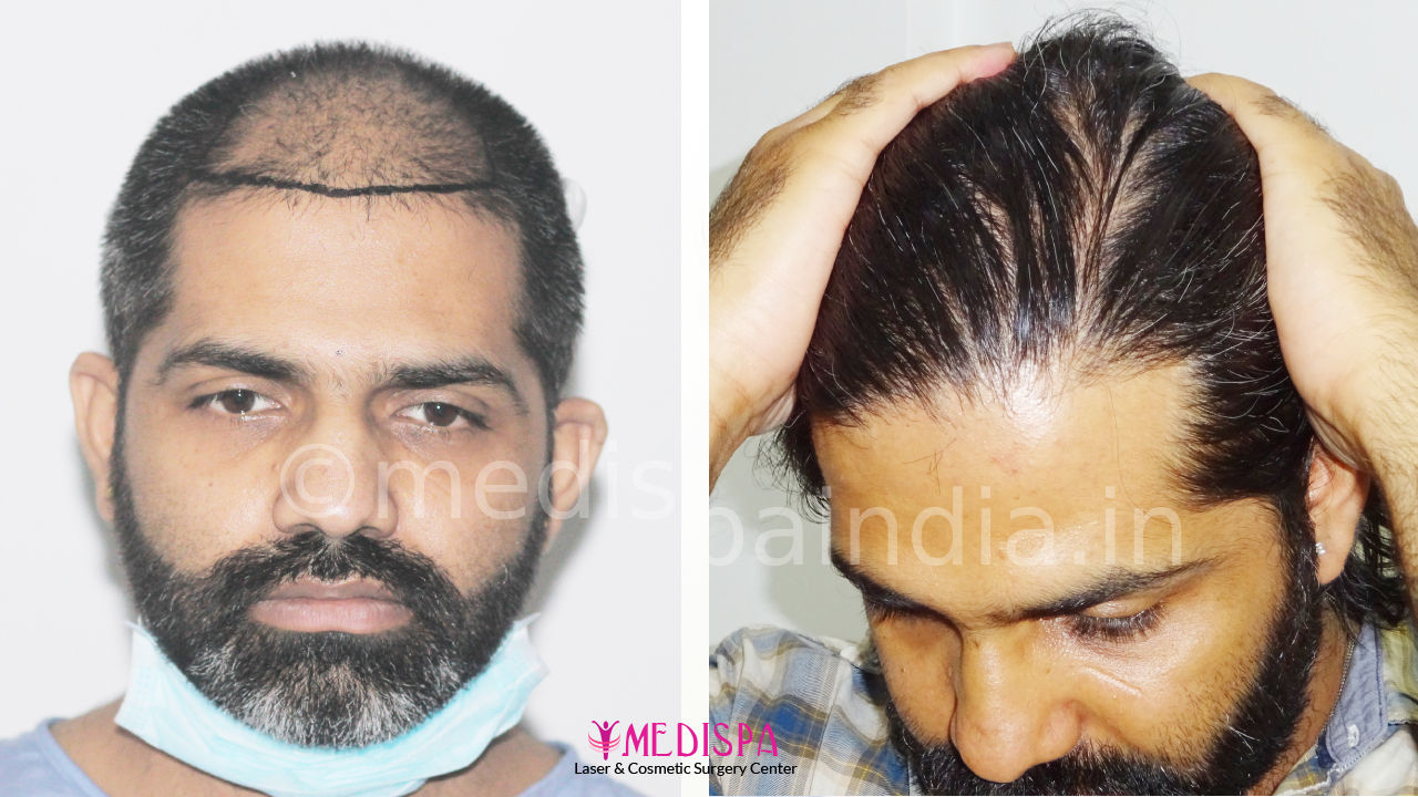 best hair transplant cost in delhi