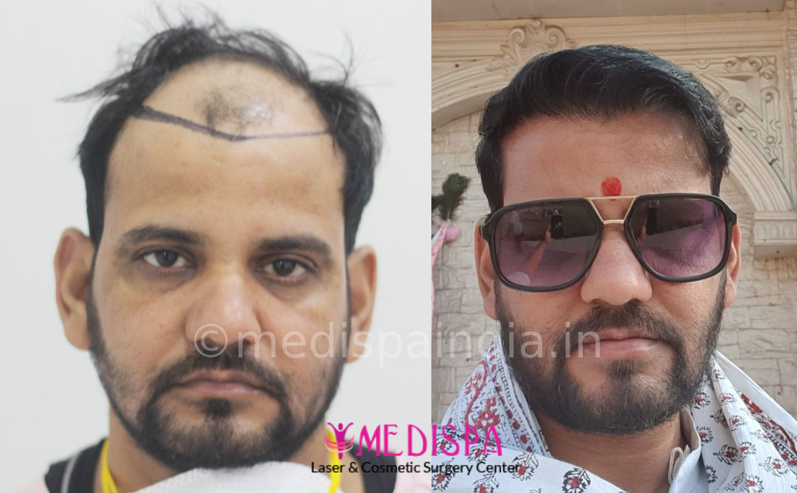 best hair transplant results in jaipur