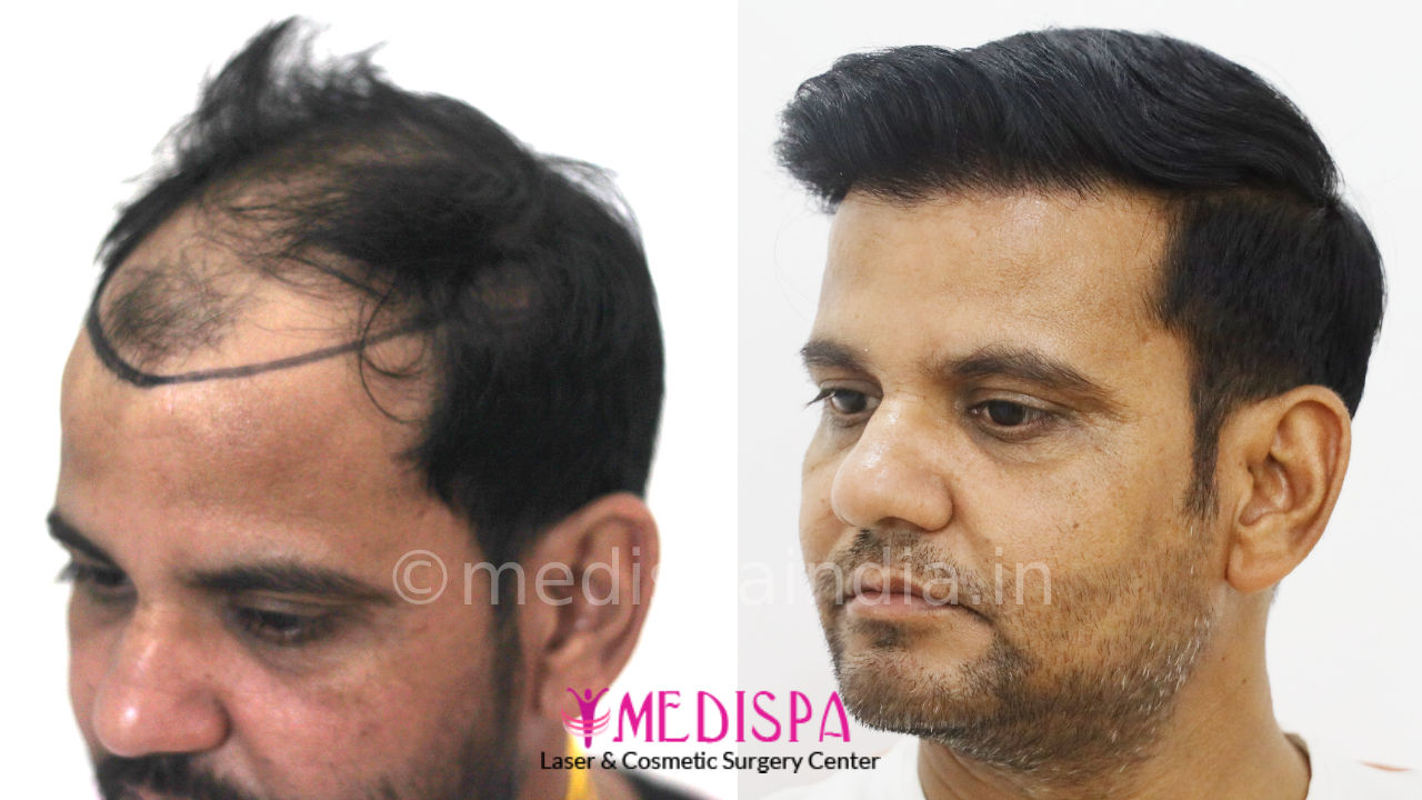 best hair transplant results