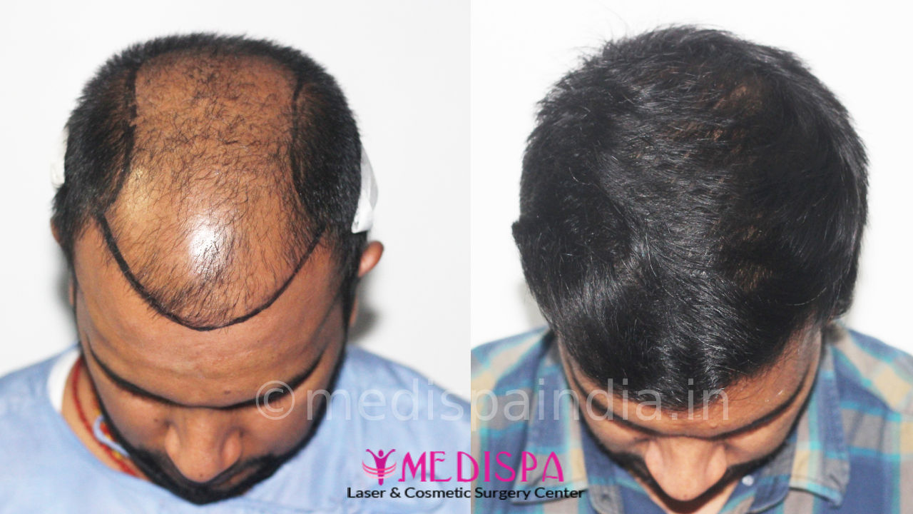 hair restoration cost in delhi india