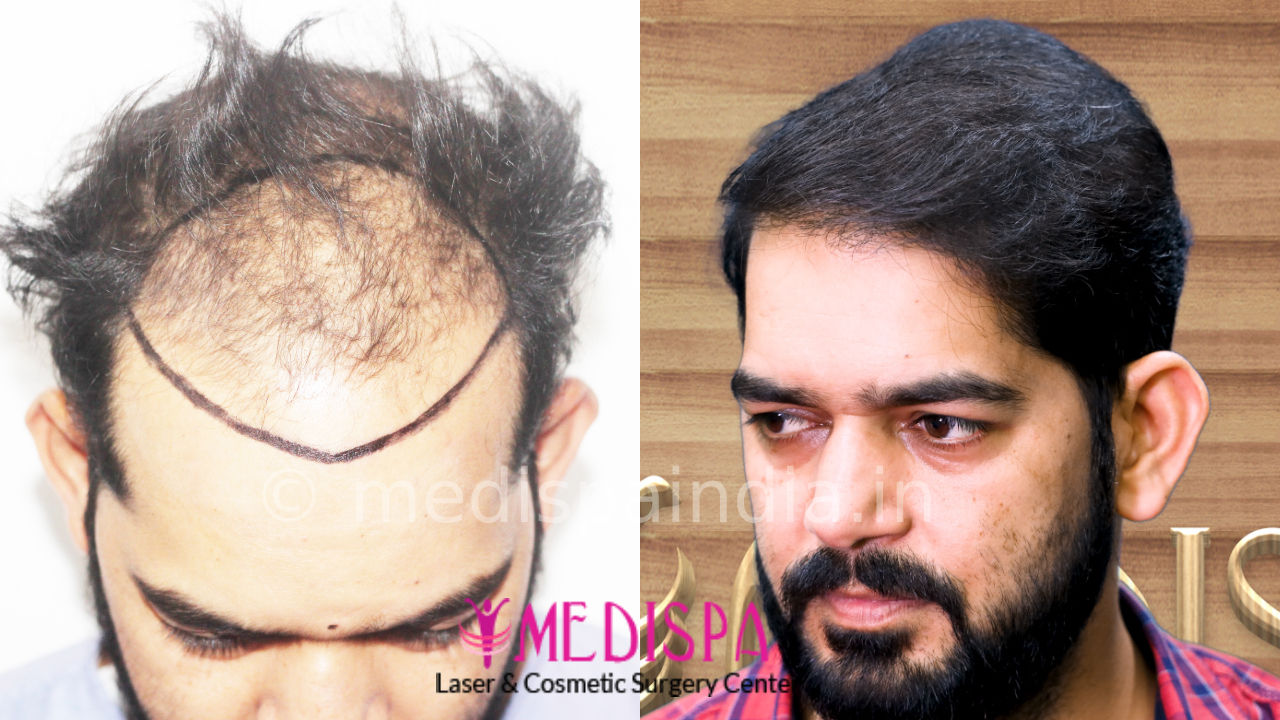 hair transplant price