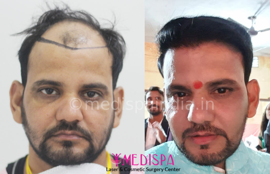 hair transplant before and after