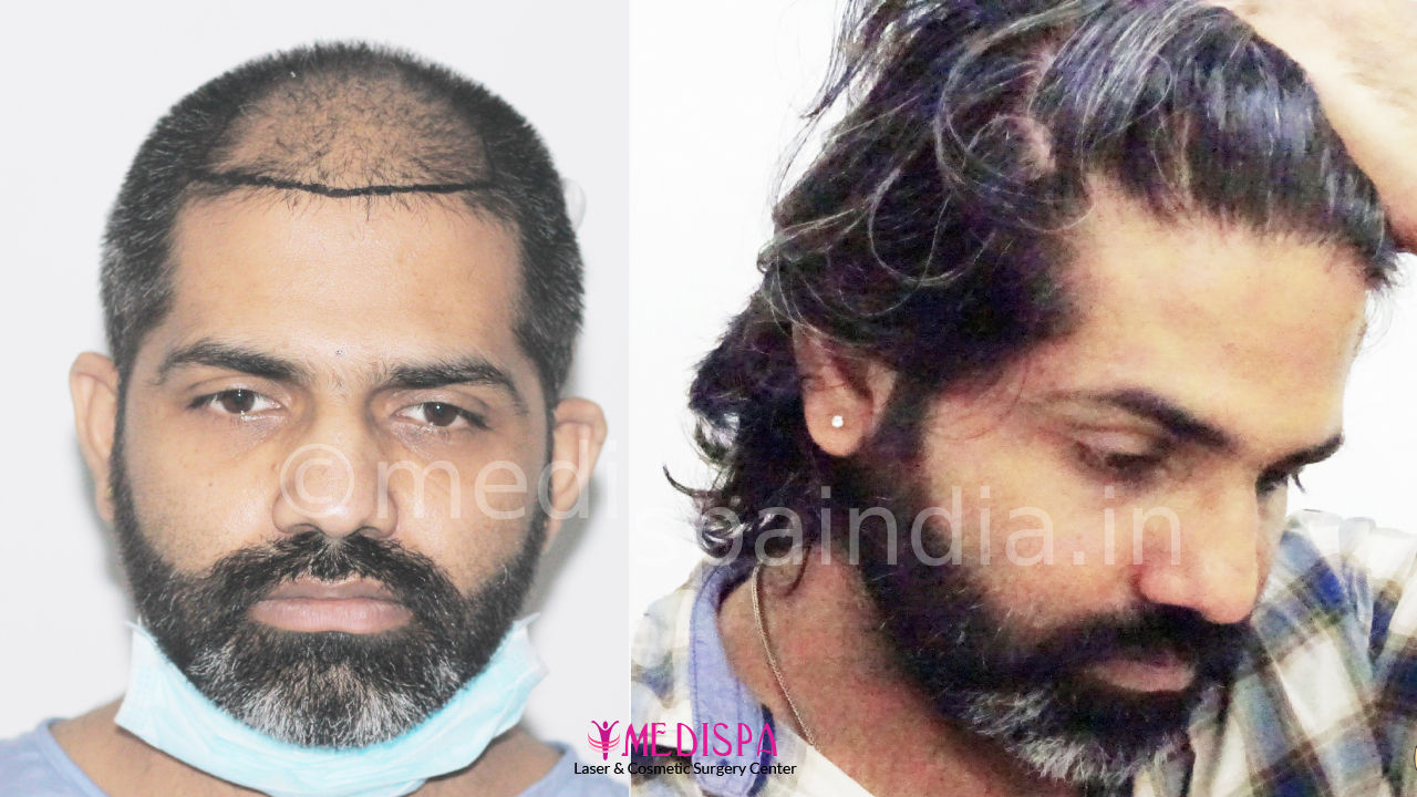 hair transplant clinic in delhi