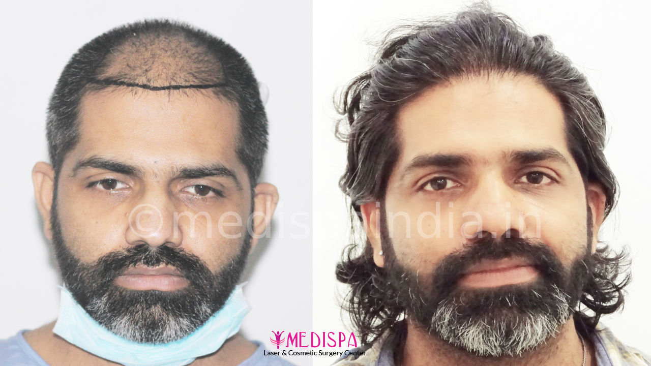 hair transplant cost in delhi