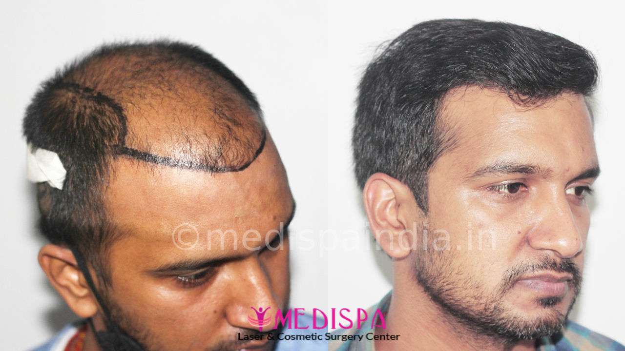 hair transplant cost in jaipur