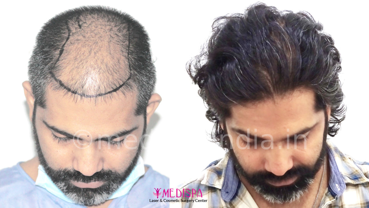 hair transplant in delhi