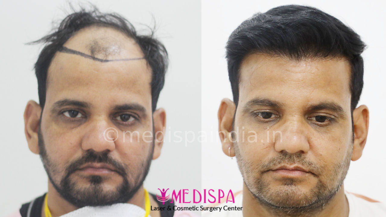 hair transplant in jaipur