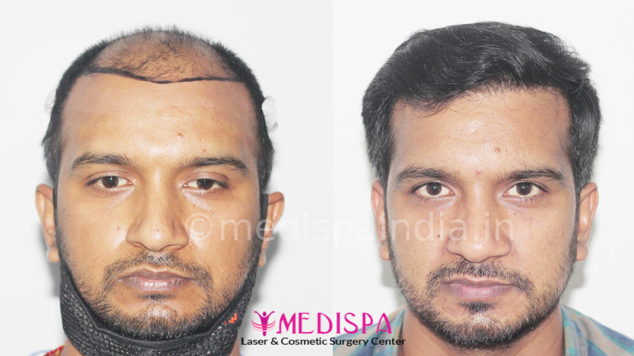 hair transplant price in delhi