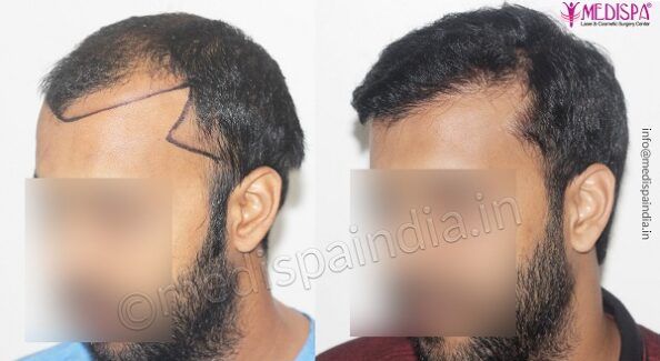 What is The Ideal Age For Hair Transplant Surgery