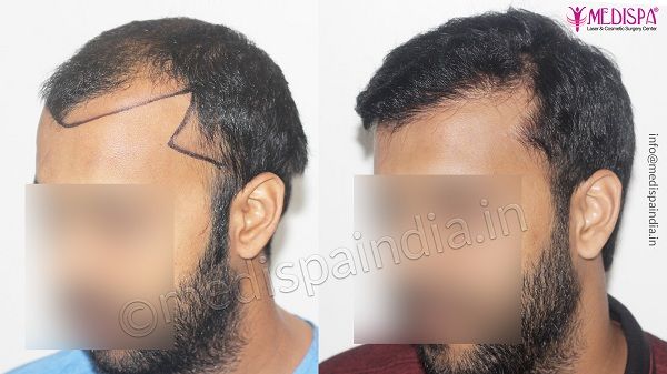 What is The Ideal Age For Hair Transplant Surgery